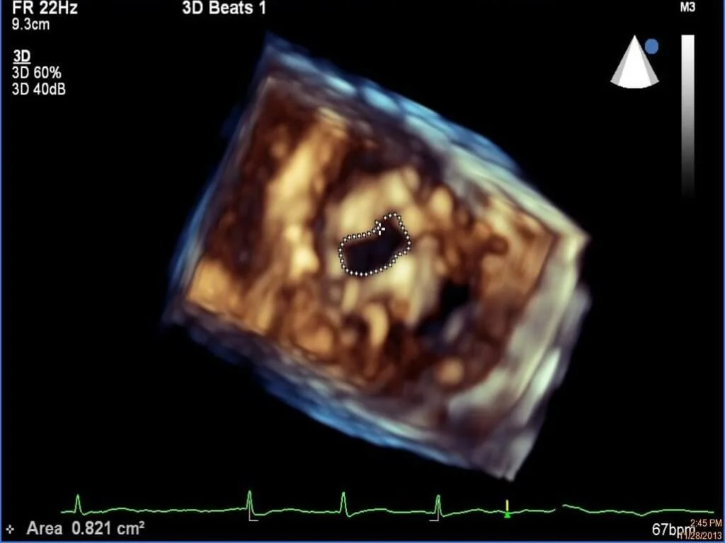 二尖瓣狹窄的3D心臟超聲波圖像