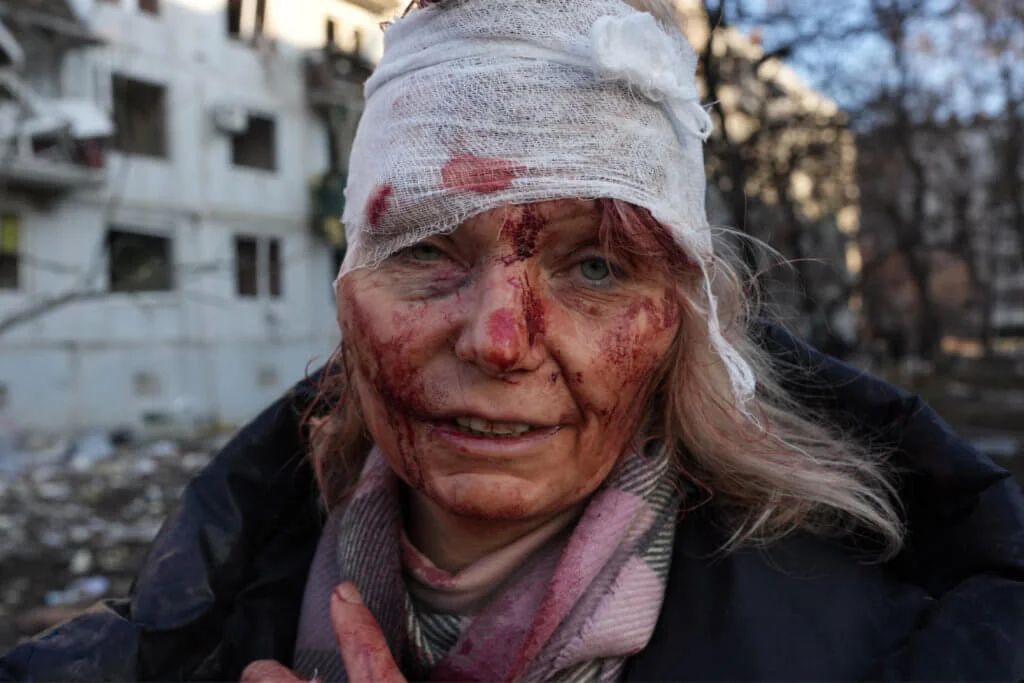 烏克蘭東部城市米達列斯，有婦人受空襲牽連受傷，血流滿面。 (Photo by Wolfgang Schwan / ANADOLU AGENCY / Anadolu Agency via AFP)