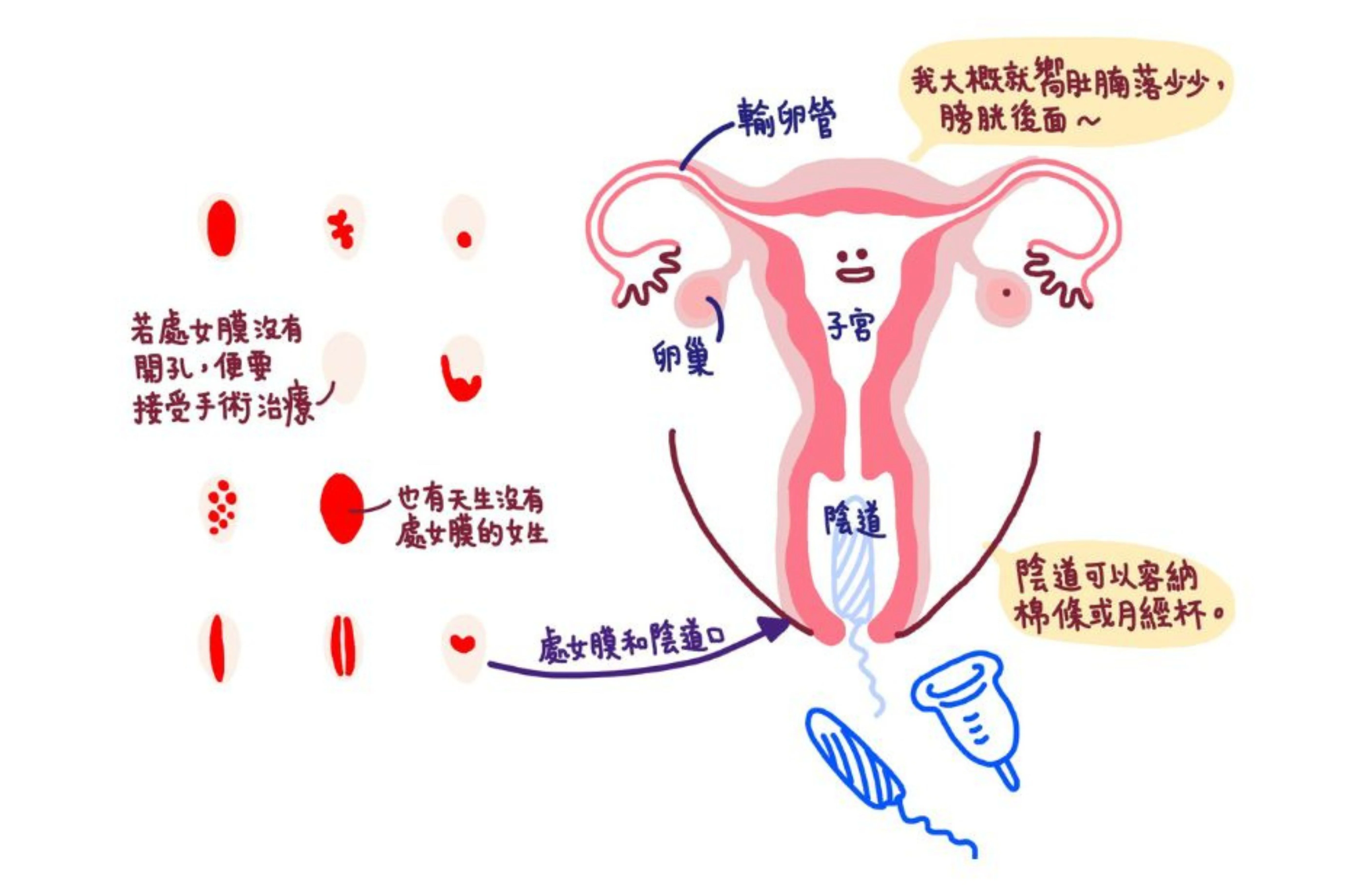 陰道冠不是一個封閉的膜，其中心有孔讓月經流過。（圖片由happeriod提供，插畫：Dora）