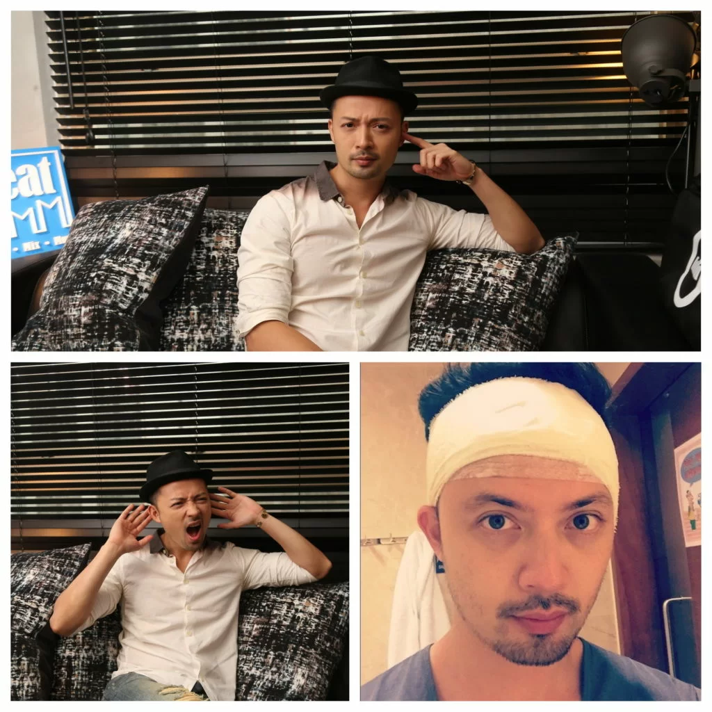 Ronny赴澳洲潛水發生意外,導致耳膜穿破,早前做了鼓室成形手術。