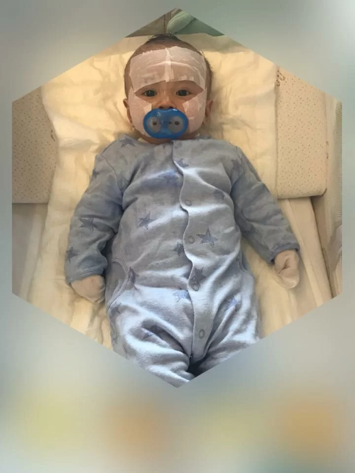 Zachary三個多月大時,曾患上急性濕疹,期間按醫生指示穿上特製衣物,令藥膏可被皮膚吸收。