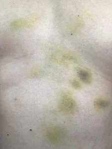 拍攝完第二天，何遠東才發現肚腩全是瘀傷。