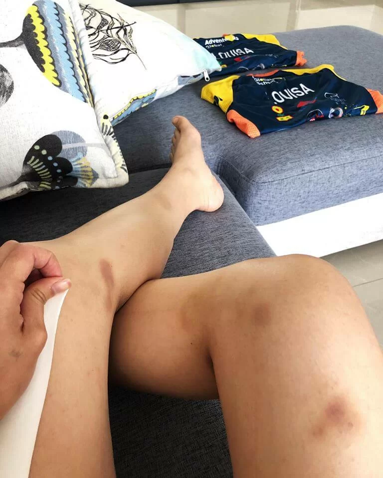 由練習到真正踏上征途,腳上都留下不少傷痕。