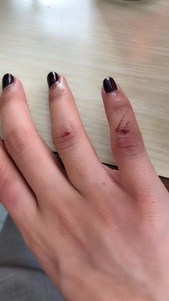 龔嘉欣拍劇致尾指斷筋，現在仍有後遺症，右手無名指及尾指無法合起來，尾指至今都感到乏力。 