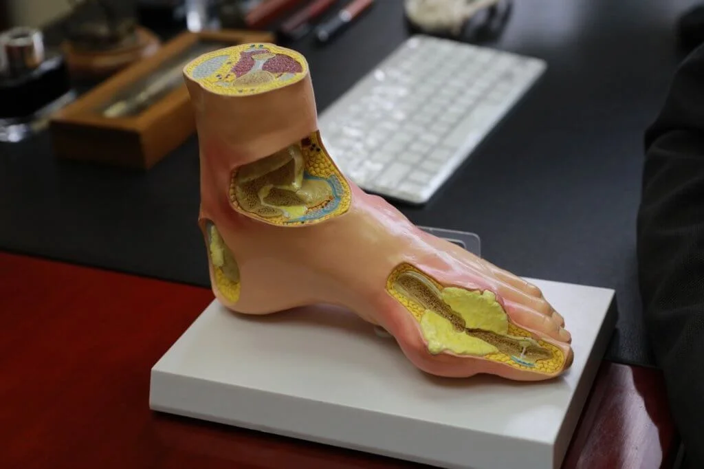 腳趾關節位形成的結晶，經過藥物治療，加上戒口大概要兩、三年才能融化。 