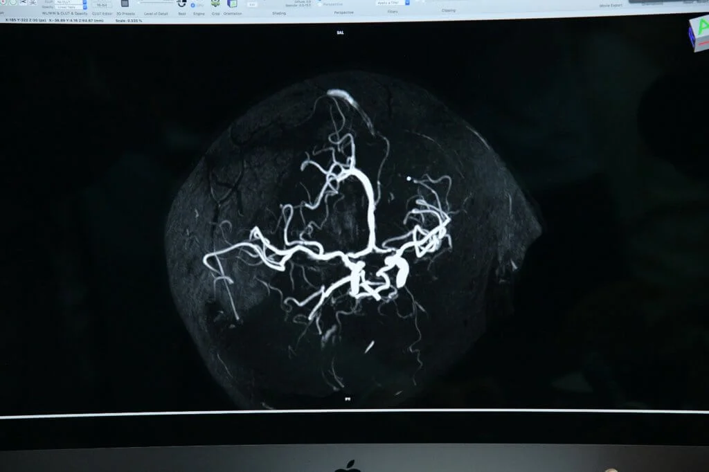 血管壁狹窄或有血管瘤,都是造成中風的因素。