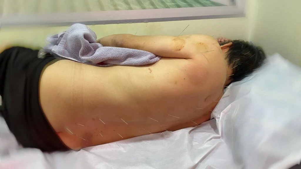 針灸令血氣運行暢順,對中風後的康復治療很有幫助。