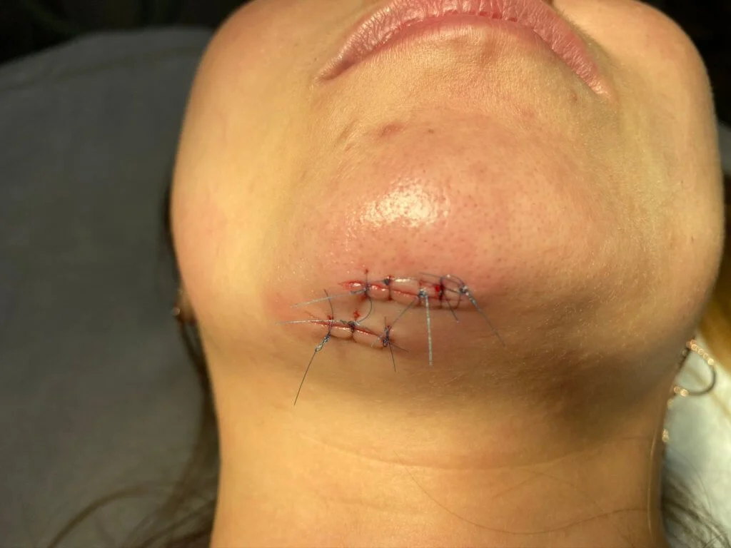 在夜店受襲後，劉晨芝的下巴縫了三十針，對唱歌也有影響。