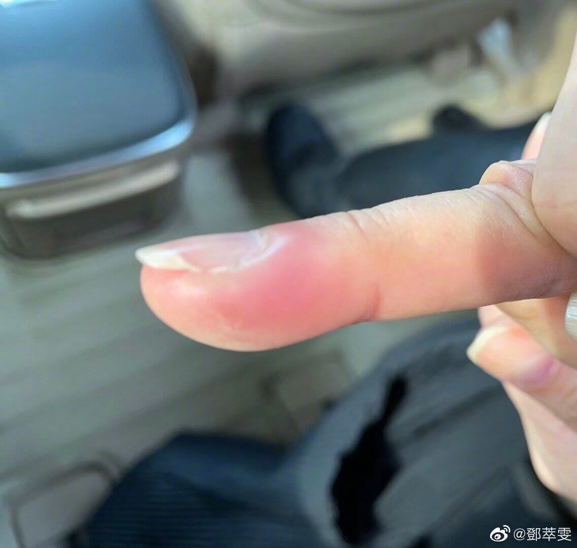 雯女因處理指甲的倒刺不當，引起發炎紅腫。