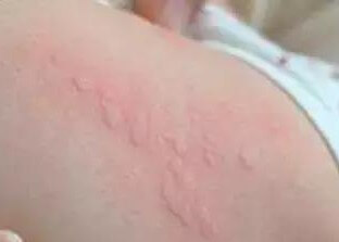 小朋友皮膚幼嫩很容易因敏感出風疹