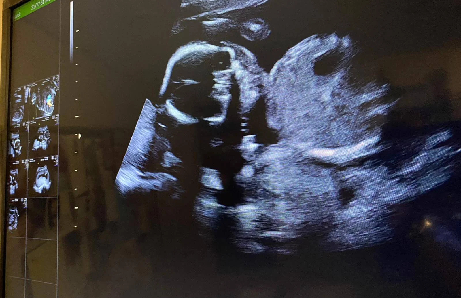  陪太太做產檢，看見腹中BB超聲波圖時，相當興奮。