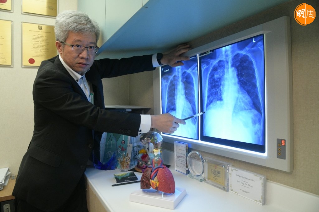 蔡醫生指肺癌採組合治療，增加了治癒機會。