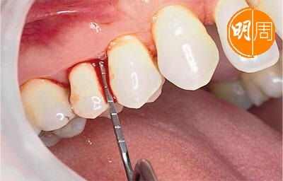 刷牙流牙血是牙周病初期的徵狀