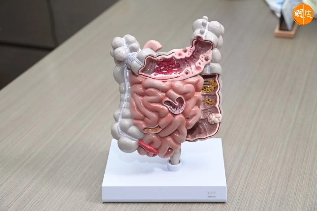 䦨尾位置在盲腸下方,盲腸被阻塞就會令䦨尾發炎。