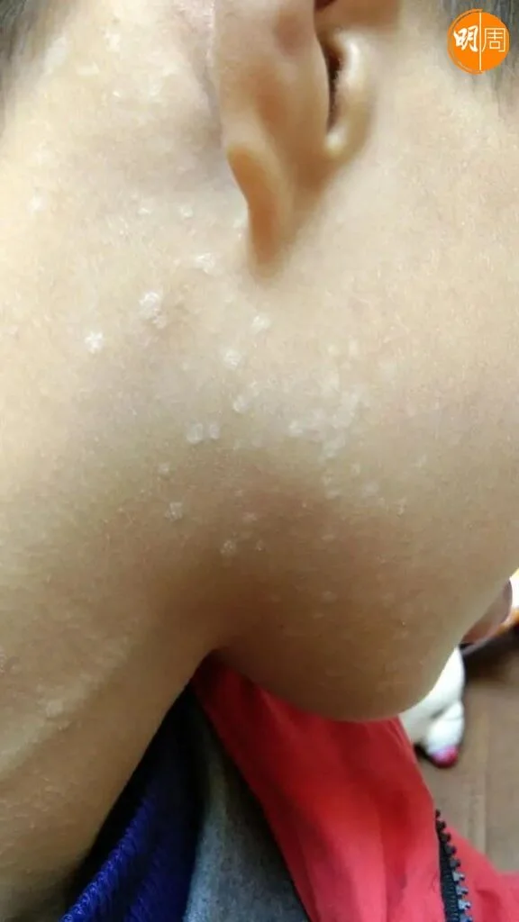 汗斑會令皮膚出現碎屑