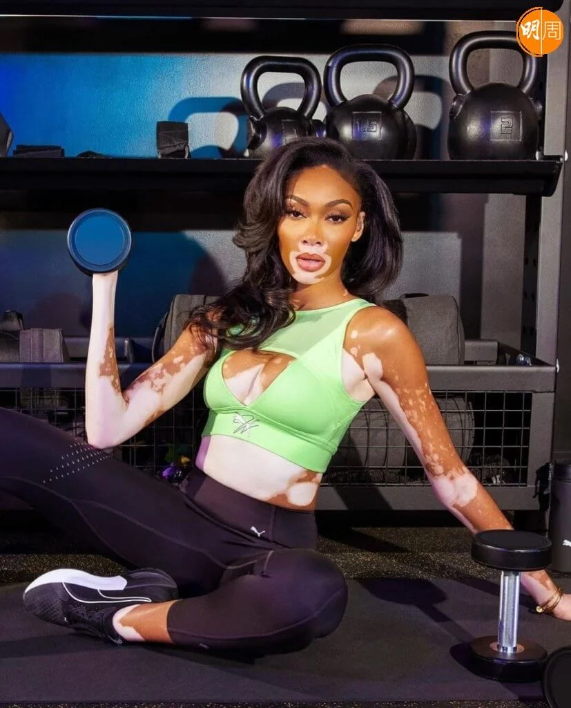 加拿大十九歲模特兒Winnie Harlow自幼因白蝕被欺凌,她選擇放下自卑接受自己。