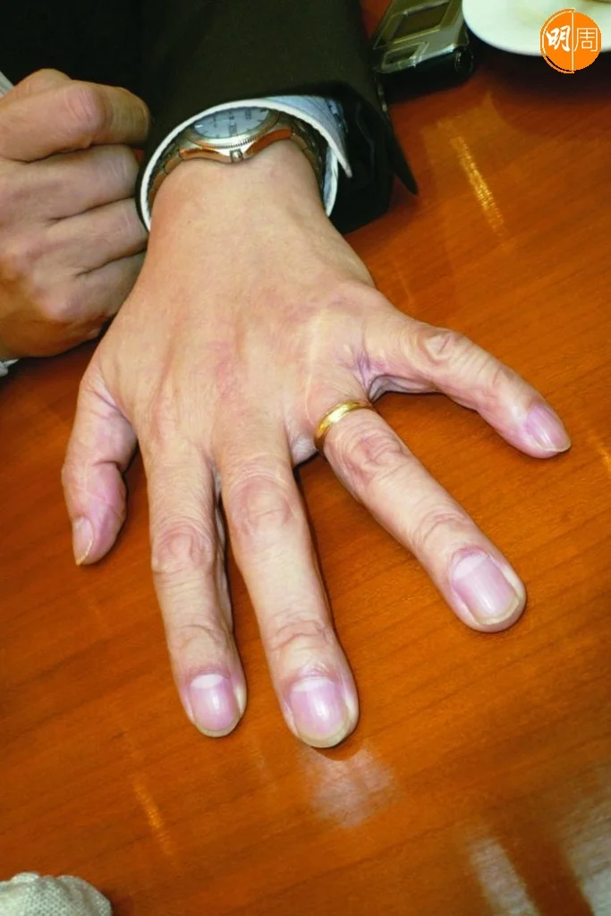 大AL手部被斬做完手術,康復多年後的狀況。