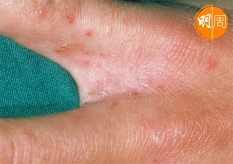 疥瘡在手指隙出現有機會被誤認為濕疹