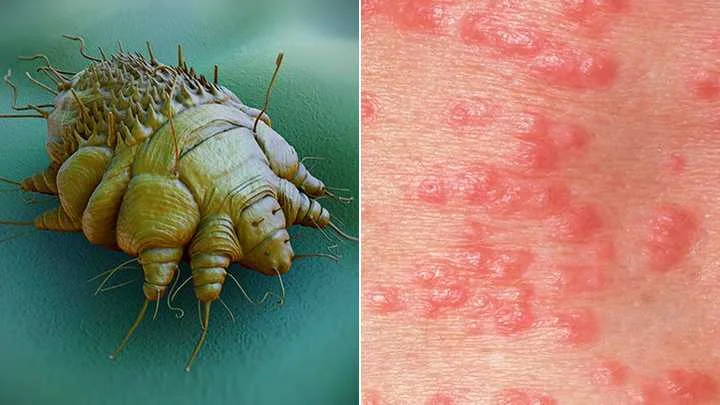 疥蟎蟲寄生在人體，一旦進入皮膚就開始繁殖。
