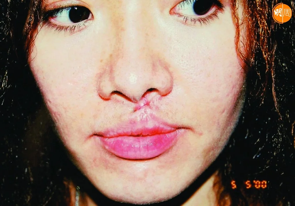 寶珮如遇上車禍後臉部受傷破相。