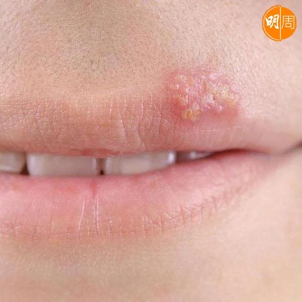 唇瘡病毒進入體內會一直匿藏在神經線內，身體抵抗力變弱時才會變得活躍。