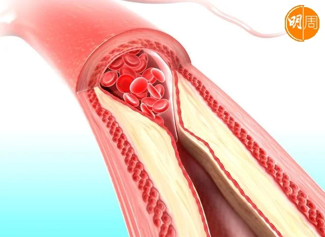 血管被斑塊堵塞會阻礙心臟將血液輸送
